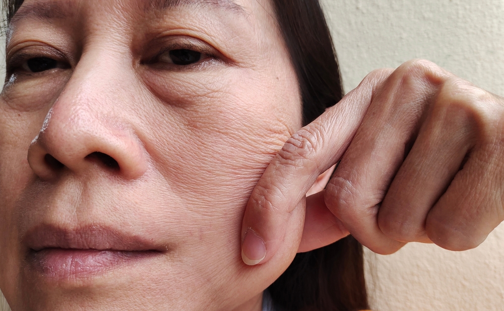 La caída de las mejillas o del tercio medio facial puede indicar que necesita un lifting de plano profundo