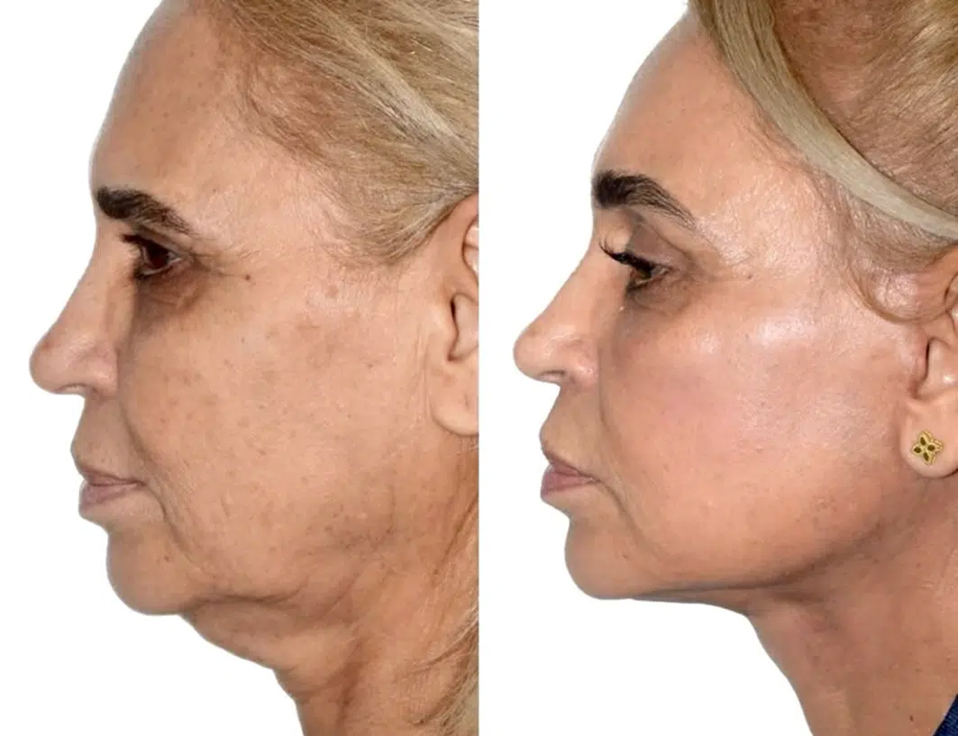 Vista lateral de antes y después de una mujer que destaca una línea mandibular más suave y rejuvenecimiento facial con lifting de plano profundo.