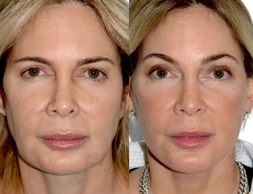 Fotos de antes y después de una mujer que muestran el progreso de recuperación del lifting facial y mejores contornos faciales durante varios meses.