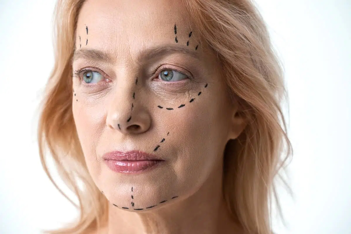 Rostro de una mujer con flechas direccionales blancas que muestran los vectores de elevación integrales utilizados en un lifting facial de plano profundo para reposicionar toda la parte media del rostro y el cuello.
