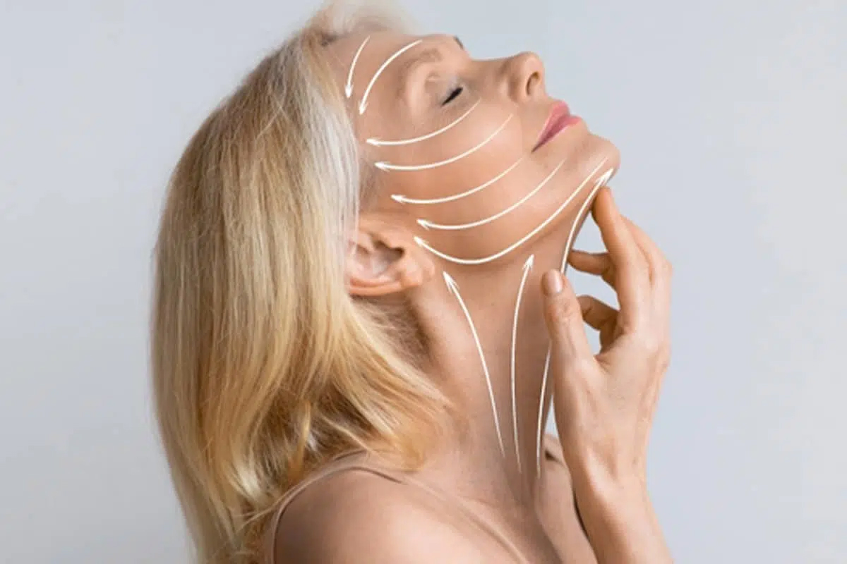 Vista de perfil de una mujer con flechas blancas que ilustran los vectores del lifting facial de plano profundo que elevan simultáneamente la línea mandibular, el cuello y la parte media del rostro para resultados duraderos.