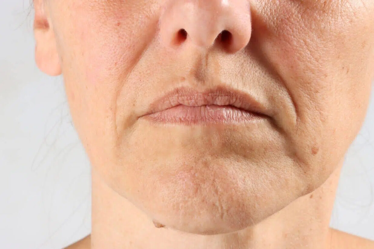 Primer plano de la parte inferior del rostro mostrando pliegues nasolabiales profundos y laxitud de la piel, indicando candidatura para un procedimiento de lifting facial