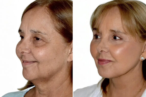 Lifting de Frente y Cejas fFotos de Antes y Después en Miami, FL, Paciente 17749