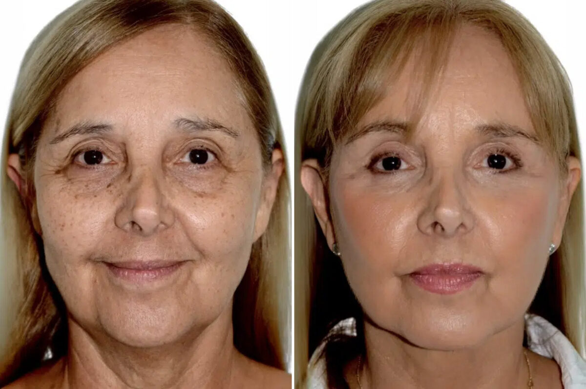 Lifting de Frente y Cejas fFotos de Antes y Después en Miami, FL, Paciente 17749