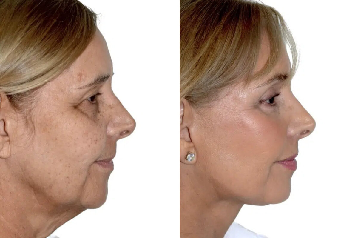 Lifting de Frente y Cejas fFotos de Antes y Después en Miami, FL, Paciente 17749