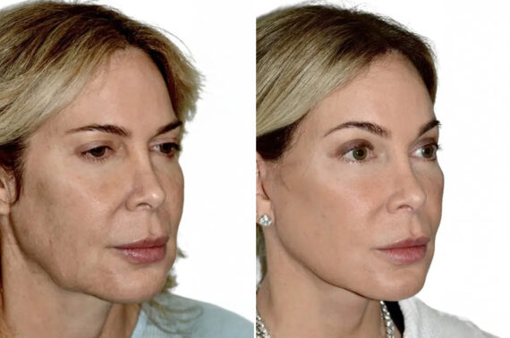 Lifting facial (facelift) fFotos de Antes y Después en Miami, FL, Paciente 17759