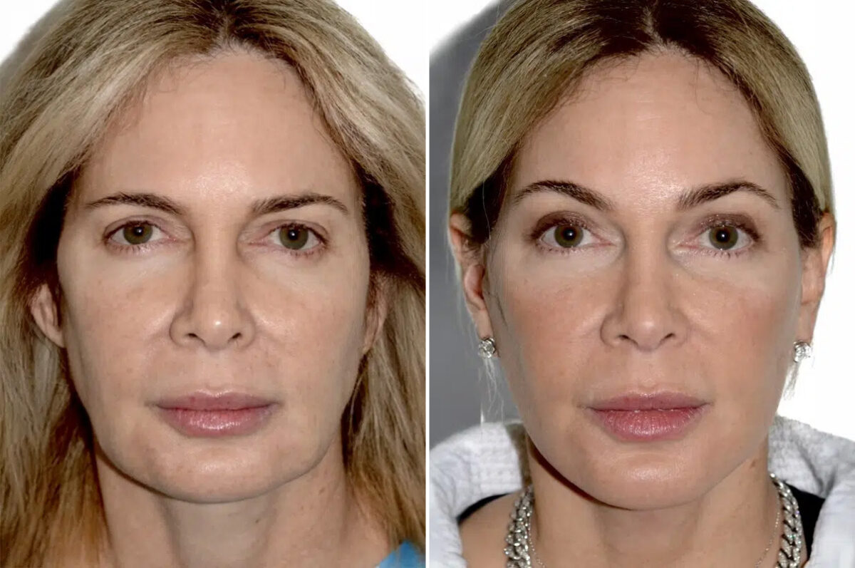 Lifting facial (facelift) fFotos de Antes y Después en Miami, FL, Paciente 17759