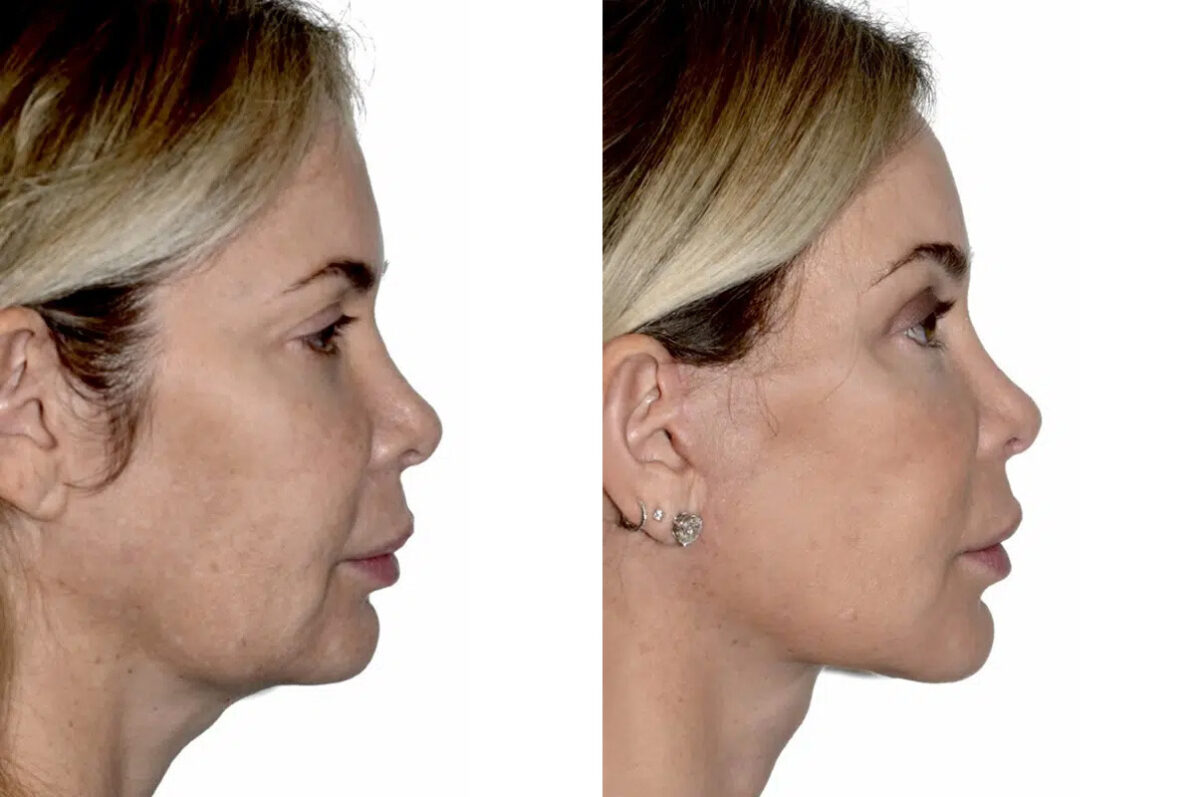 Lifting facial (facelift) fFotos de Antes y Después en Miami, FL, Paciente 17759