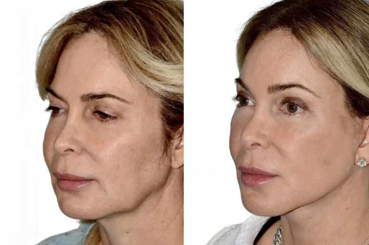 Lifting facial (facelift) fFotos de Antes y Después en Miami, FL, Paciente 17759