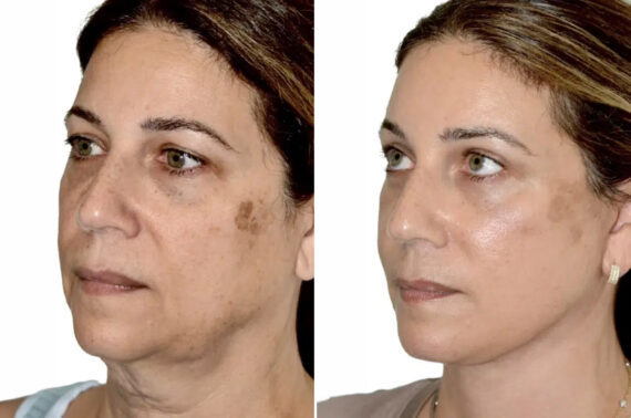 Lifting de Frente y Cejas fFotos de Antes y Después en Miami, FL, Paciente 17772