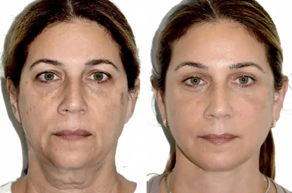 Lifting de Frente y Cejas fFotos de Antes y Después en Miami, FL, Paciente 17772