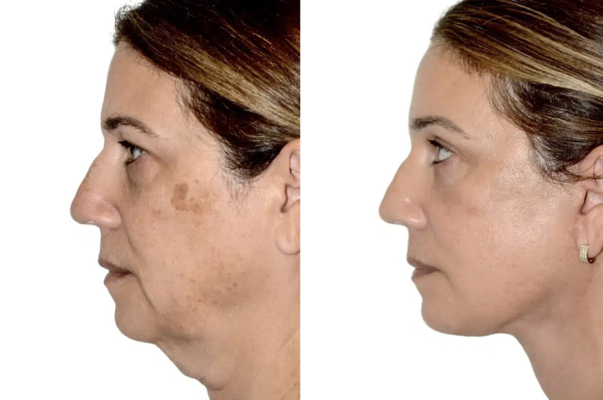 Lifting de Frente y Cejas fFotos de Antes y Después en Miami, FL, Paciente 17772
