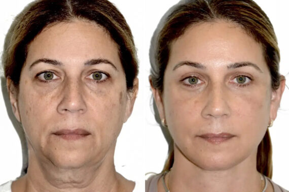 Lifting de Frente y Cejas fFotos de Antes y Después en Miami, FL, Paciente 17772