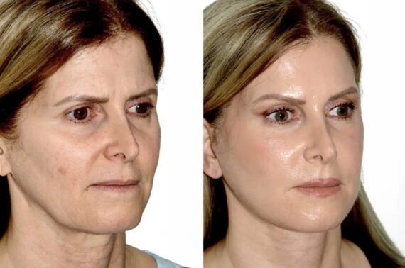 Lifting de Frente y Cejas fFotos de Antes y Después en Miami, FL, Paciente 17782