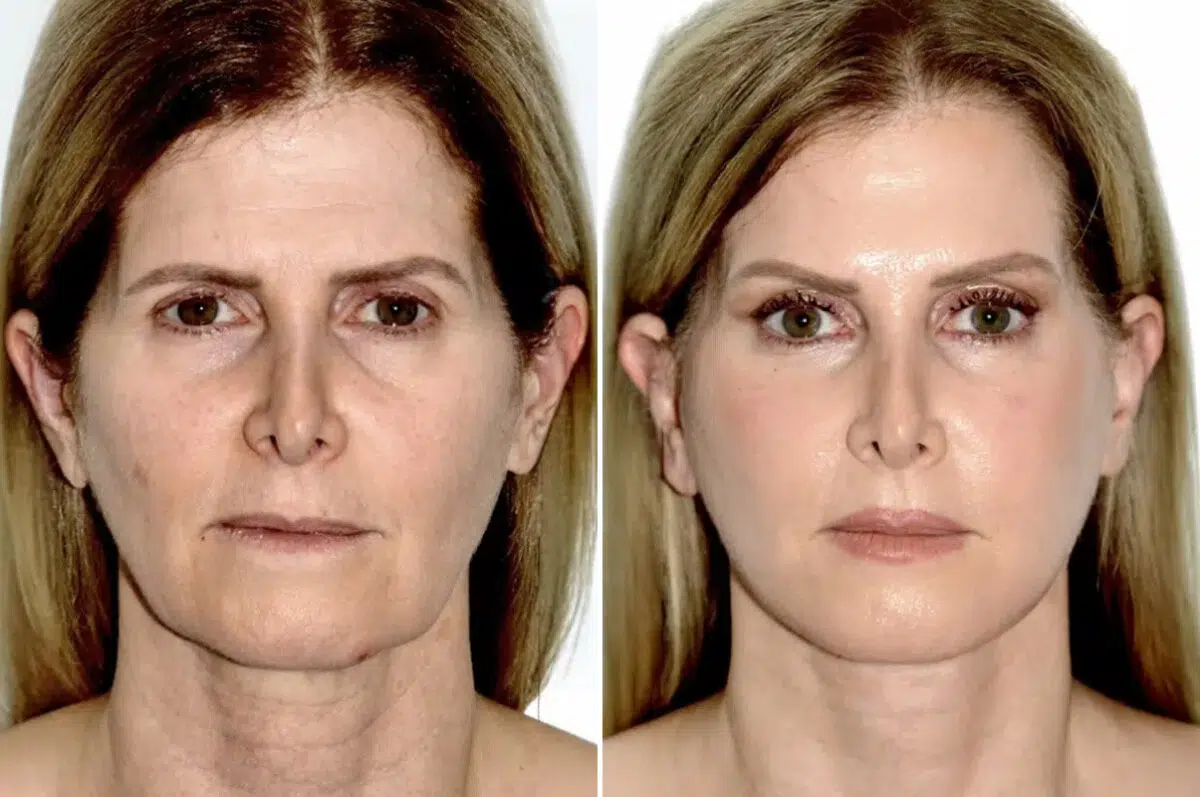 Lifting de Frente y Cejas fFotos de Antes y Después en Miami, FL, Paciente 17782