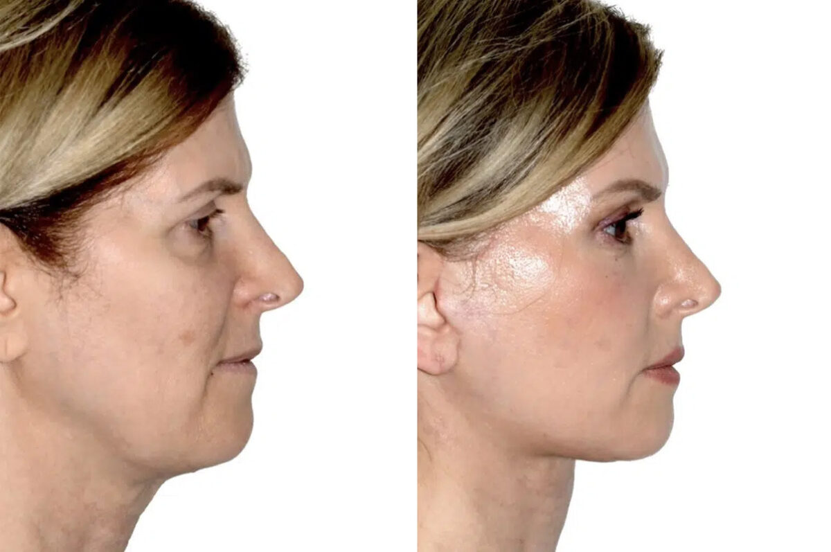 Lifting de Frente y Cejas fFotos de Antes y Después en Miami, FL, Paciente 17782