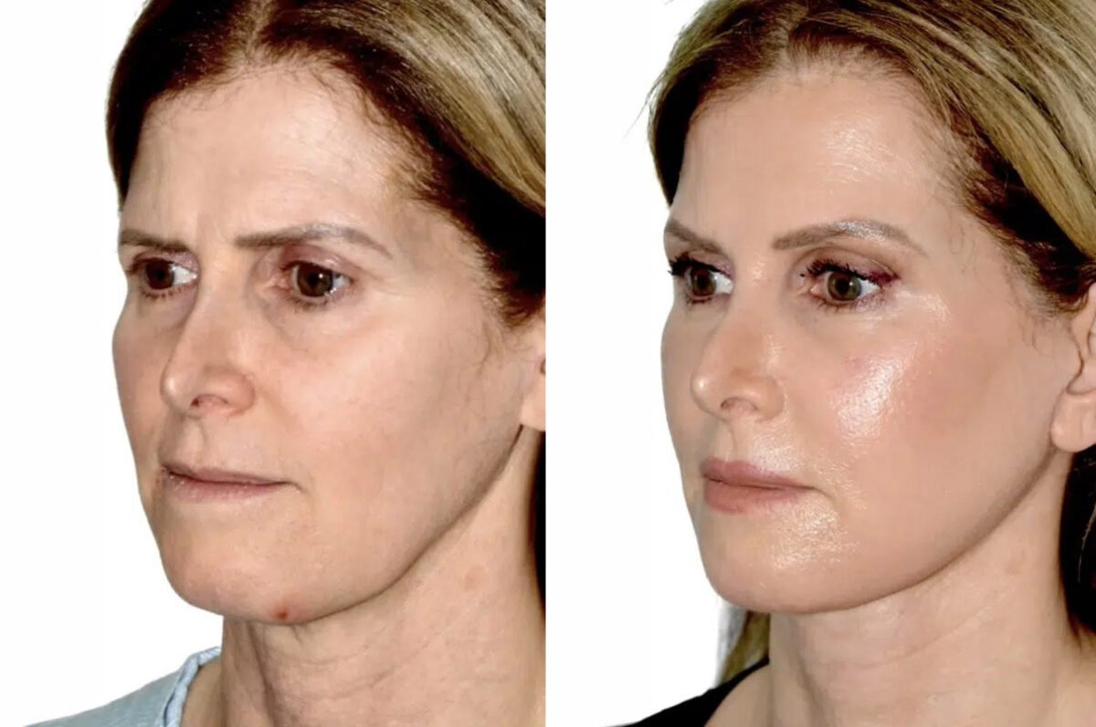 Lifting de Frente y Cejas fFotos de Antes y Después en Miami, FL, Paciente 17782