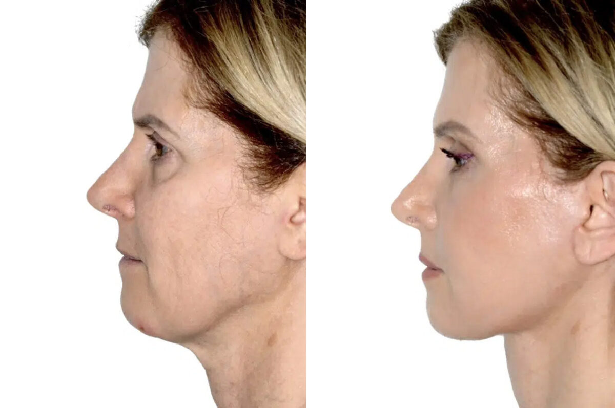 Lifting de Frente y Cejas fFotos de Antes y Después en Miami, FL, Paciente 17782
