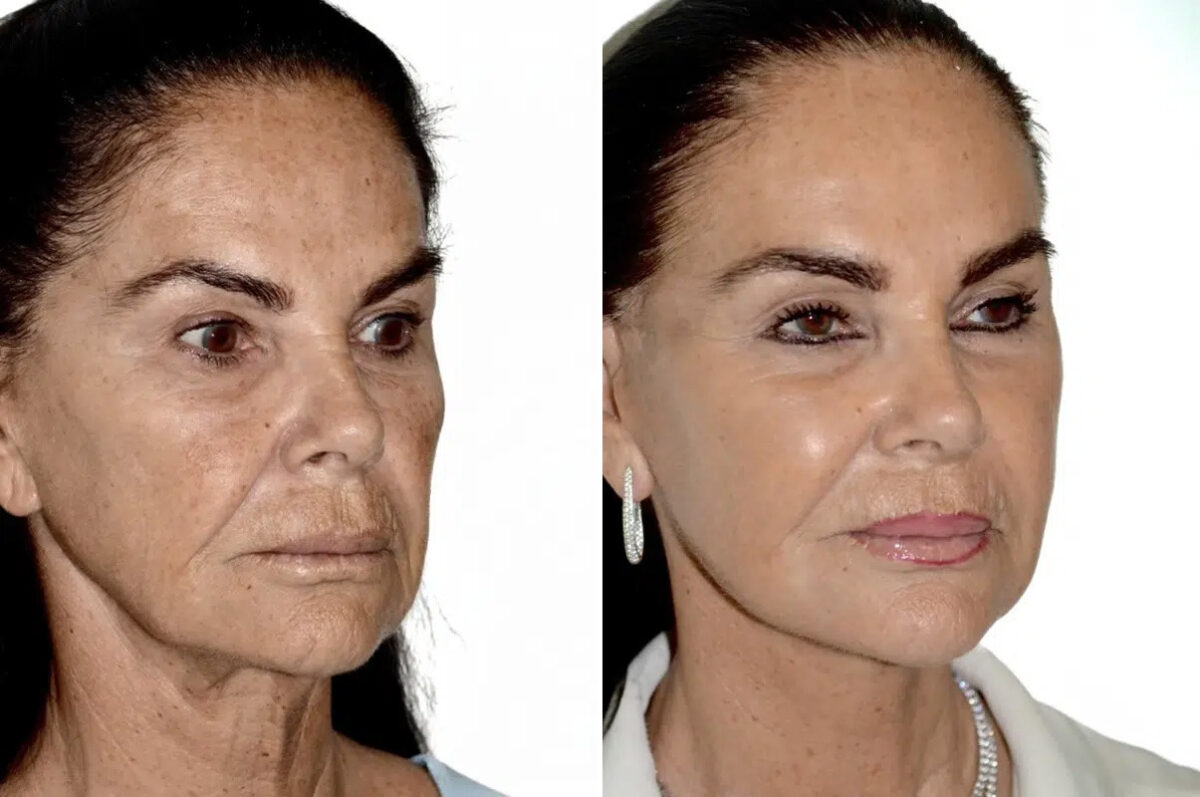 Lifting facial (facelift) fFotos de Antes y Después en Miami, FL, Paciente 17798