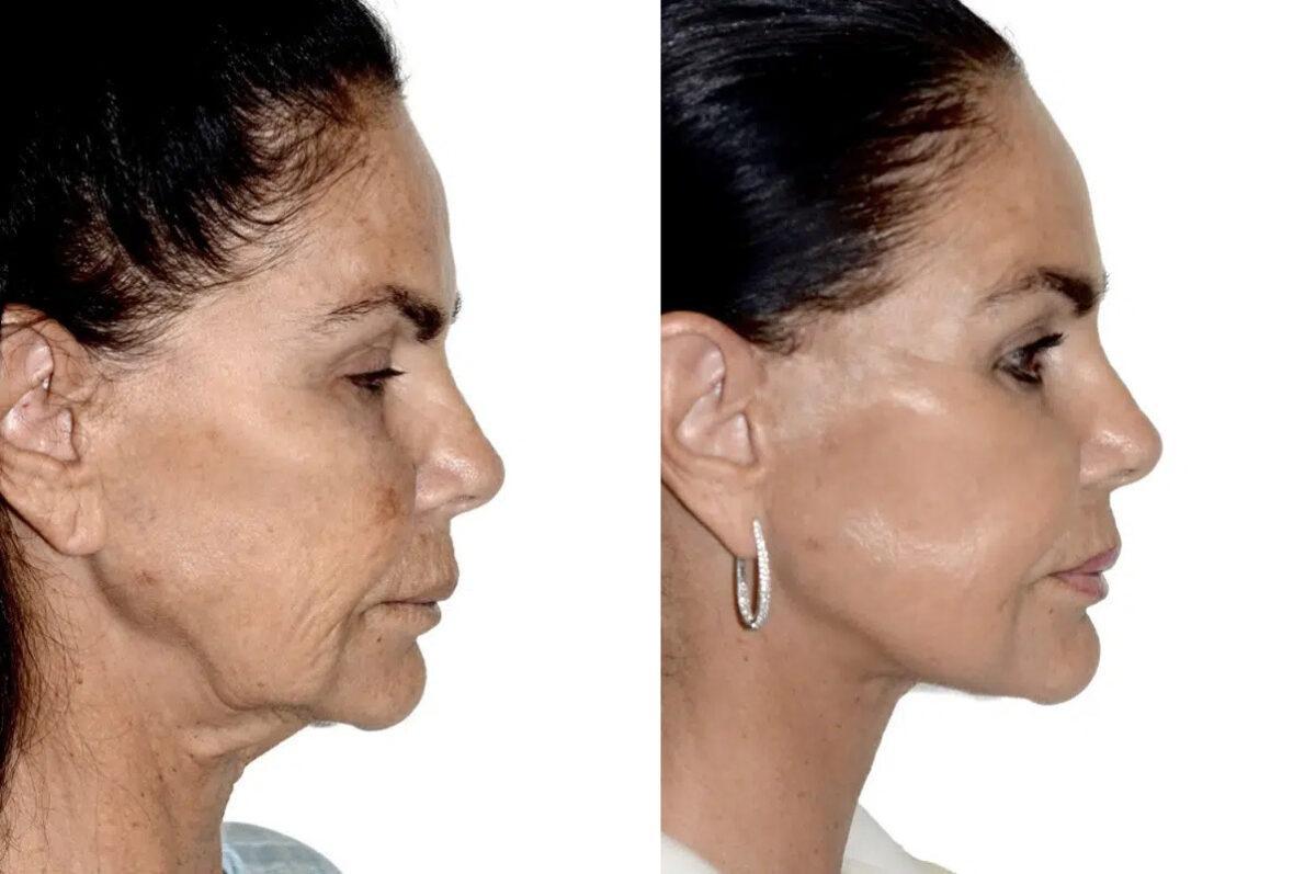 Lifting facial (facelift) fFotos de Antes y Después en Miami, FL, Paciente 17798