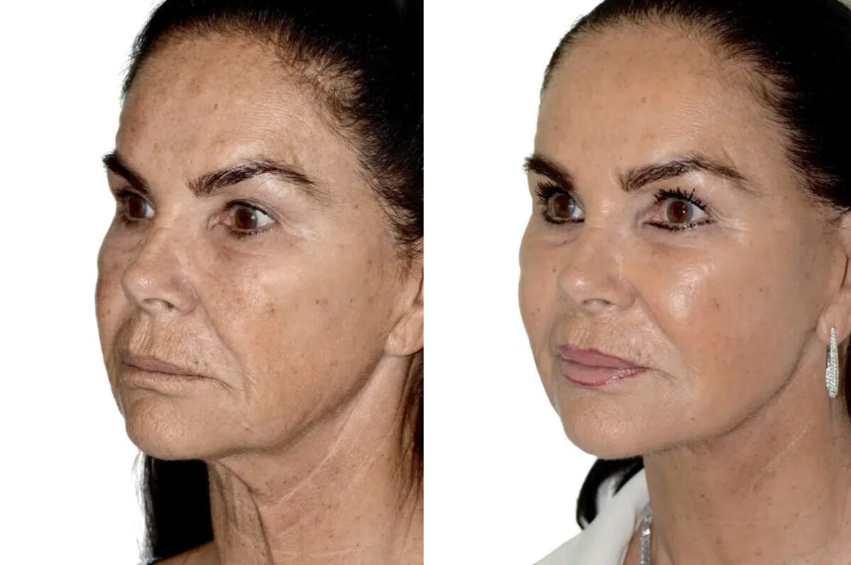 Lifting facial (facelift) fFotos de Antes y Después en Miami, FL, Paciente 17798