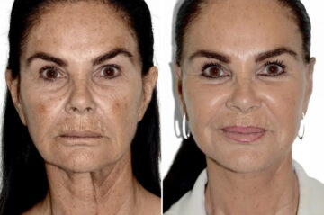 Lifting facial (facelift) fFotos de Antes y Después en Miami, FL, Paciente 17798