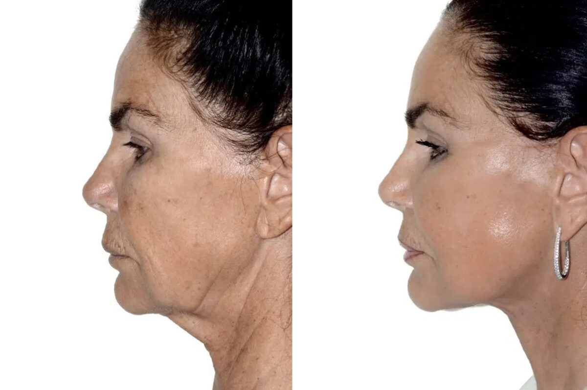 Lifting facial (facelift) fFotos de Antes y Después en Miami, FL, Paciente 17798