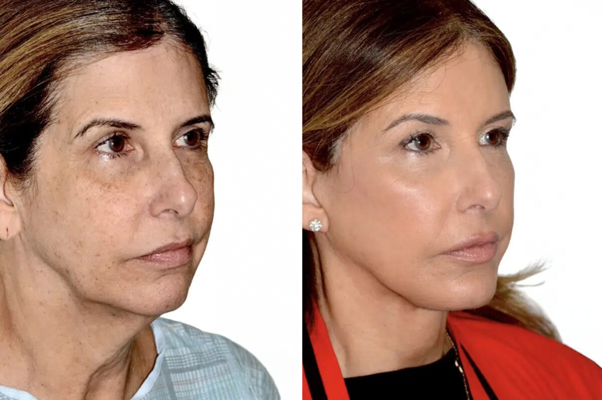 Lifting de Frente y Cejas fFotos de Antes y Después en Miami, FL, Paciente 17814