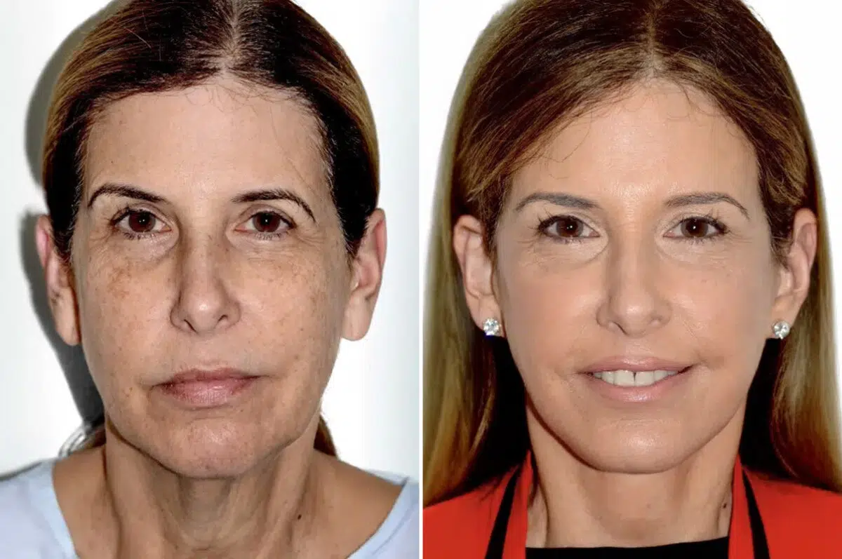 Lifting de Frente y Cejas fFotos de Antes y Después en Miami, FL, Paciente 17814