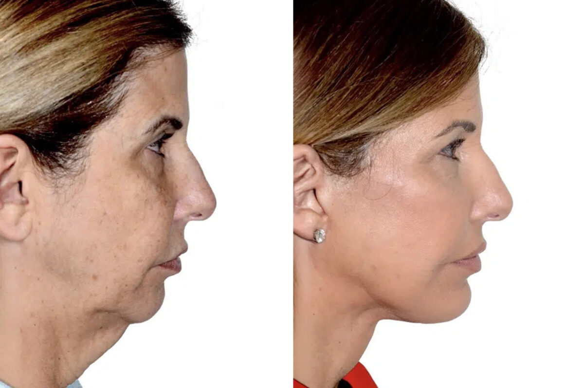 Lifting de Frente y Cejas fFotos de Antes y Después en Miami, FL, Paciente 17814