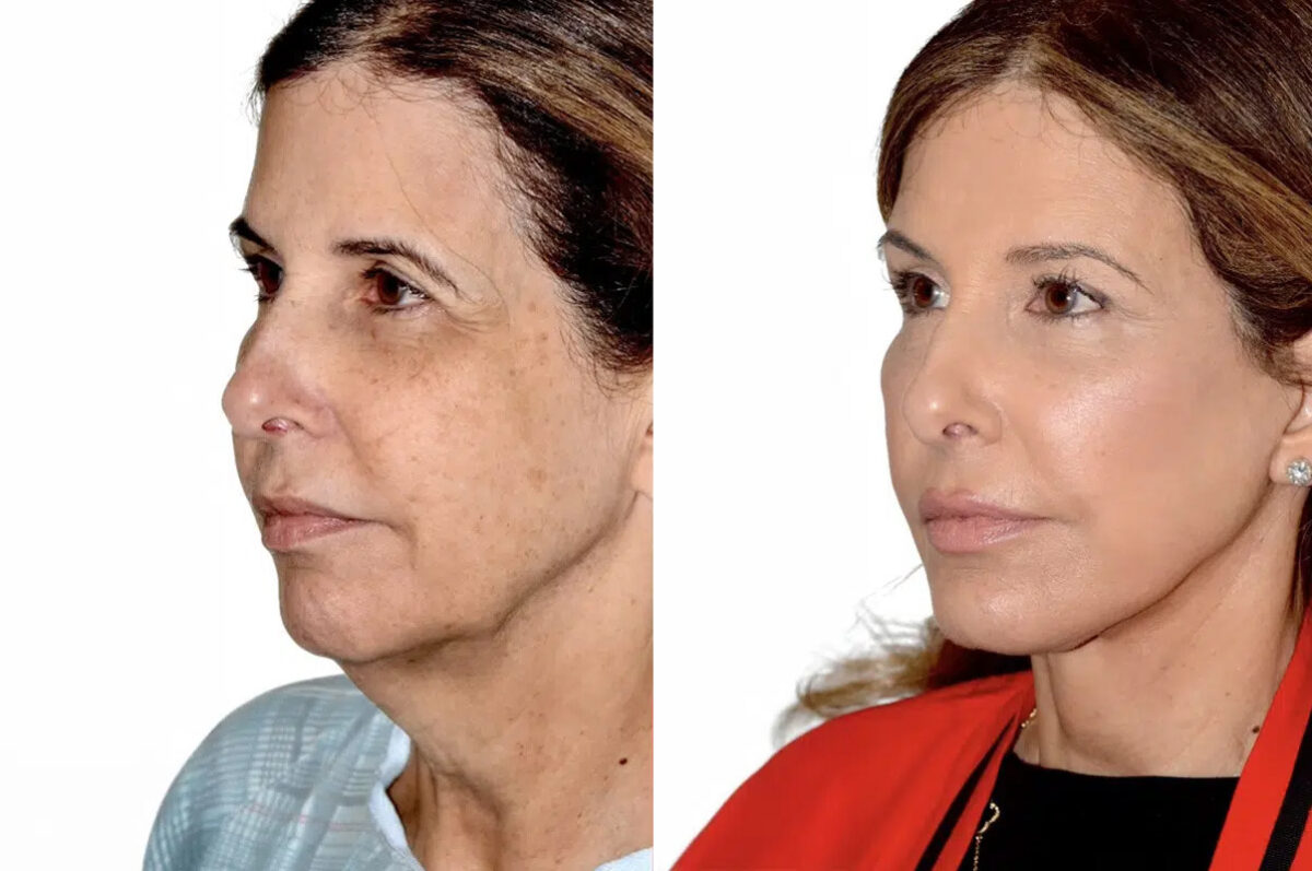 Lifting de Frente y Cejas fFotos de Antes y Después en Miami, FL, Paciente 17814