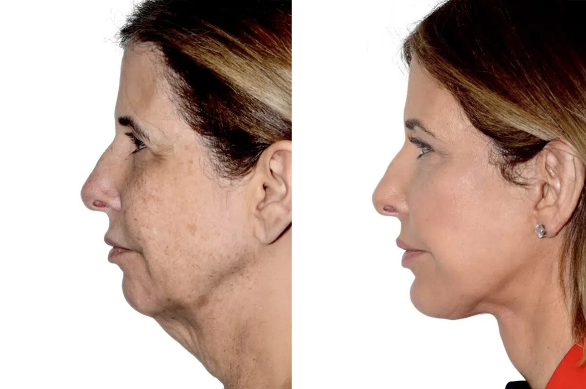 Lifting de Frente y Cejas fFotos de Antes y Después en Miami, FL, Paciente 17814