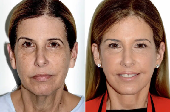 Lifting de Frente y Cejas fFotos de Antes y Después en Miami, FL, Paciente 17814