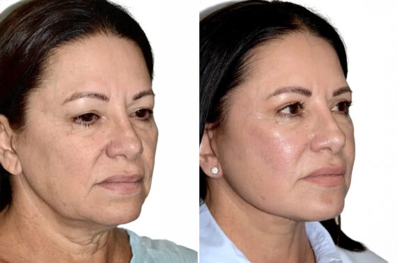 Lifting facial (facelift) fFotos de Antes y Después en Miami, FL, Paciente 17830