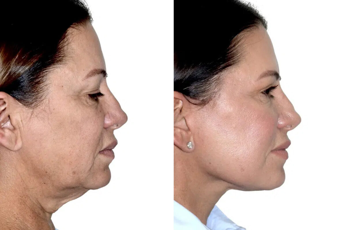 Lifting facial (facelift) fFotos de Antes y Después en Miami, FL, Paciente 17830
