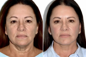 Lifting facial (facelift) fFotos de Antes y Después en Miami, FL, Paciente 17830