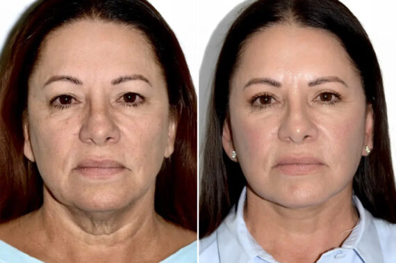 Lifting facial (facelift) fFotos de Antes y Después en Miami, FL, Paciente 17830
