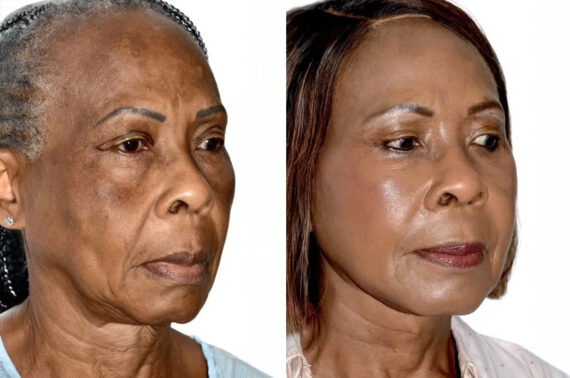 Lifting facial (facelift) fFotos de Antes y Después en Miami, FL, Paciente 17840
