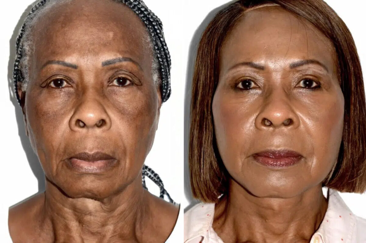 Lifting facial (facelift) fFotos de Antes y Después en Miami, FL, Paciente 17840