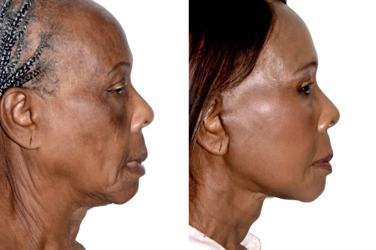 Lifting facial (facelift) fFotos de Antes y Después en Miami, FL, Paciente 17840