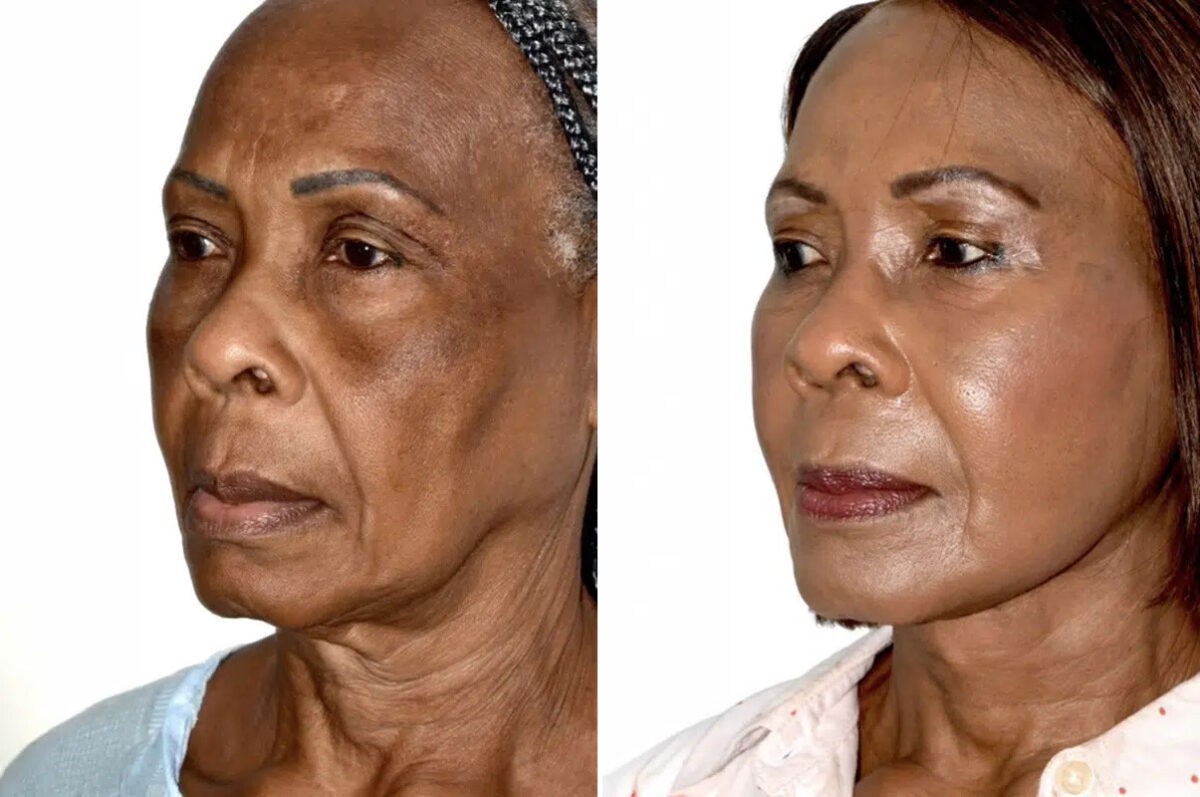 Lifting facial (facelift) fFotos de Antes y Después en Miami, FL, Paciente 17840