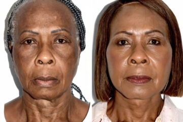 Lifting facial (facelift) fFotos de Antes y Después en Miami, FL, Paciente 17840