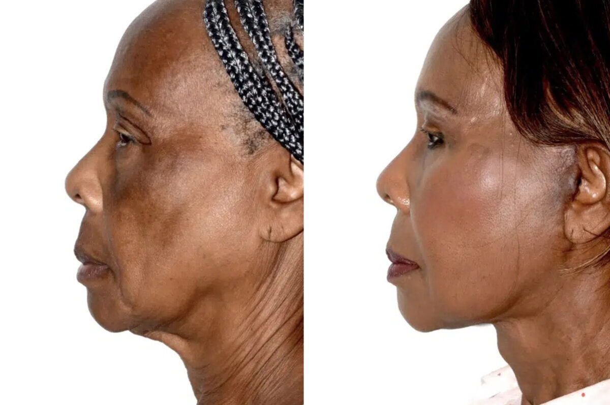 Lifting facial (facelift) fFotos de Antes y Después en Miami, FL, Paciente 17840