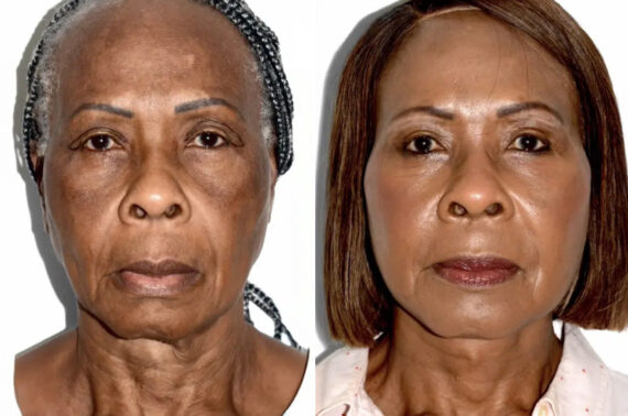 Lifting facial (facelift) fFotos de Antes y Después en Miami, FL, Paciente 17840