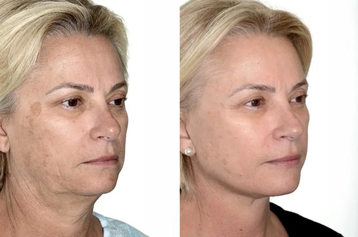 Lifting facial (facelift) fFotos de Antes y Después en Miami, FL, Paciente 17856