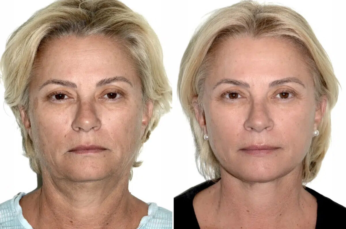 Lifting facial (facelift) fFotos de Antes y Después en Miami, FL, Paciente 17856