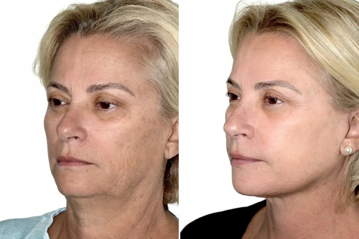 Lifting facial (facelift) fFotos de Antes y Después en Miami, FL, Paciente 17856