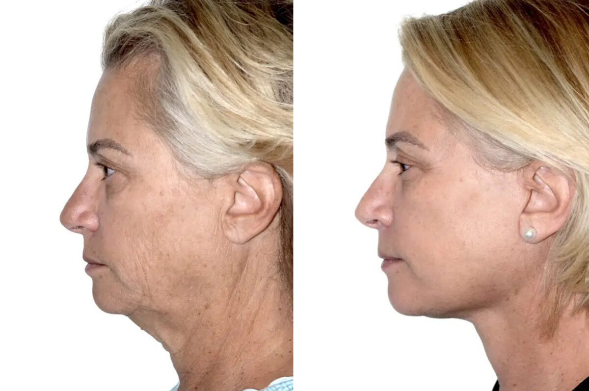 Lifting facial (facelift) fFotos de Antes y Después en Miami, FL, Paciente 17856