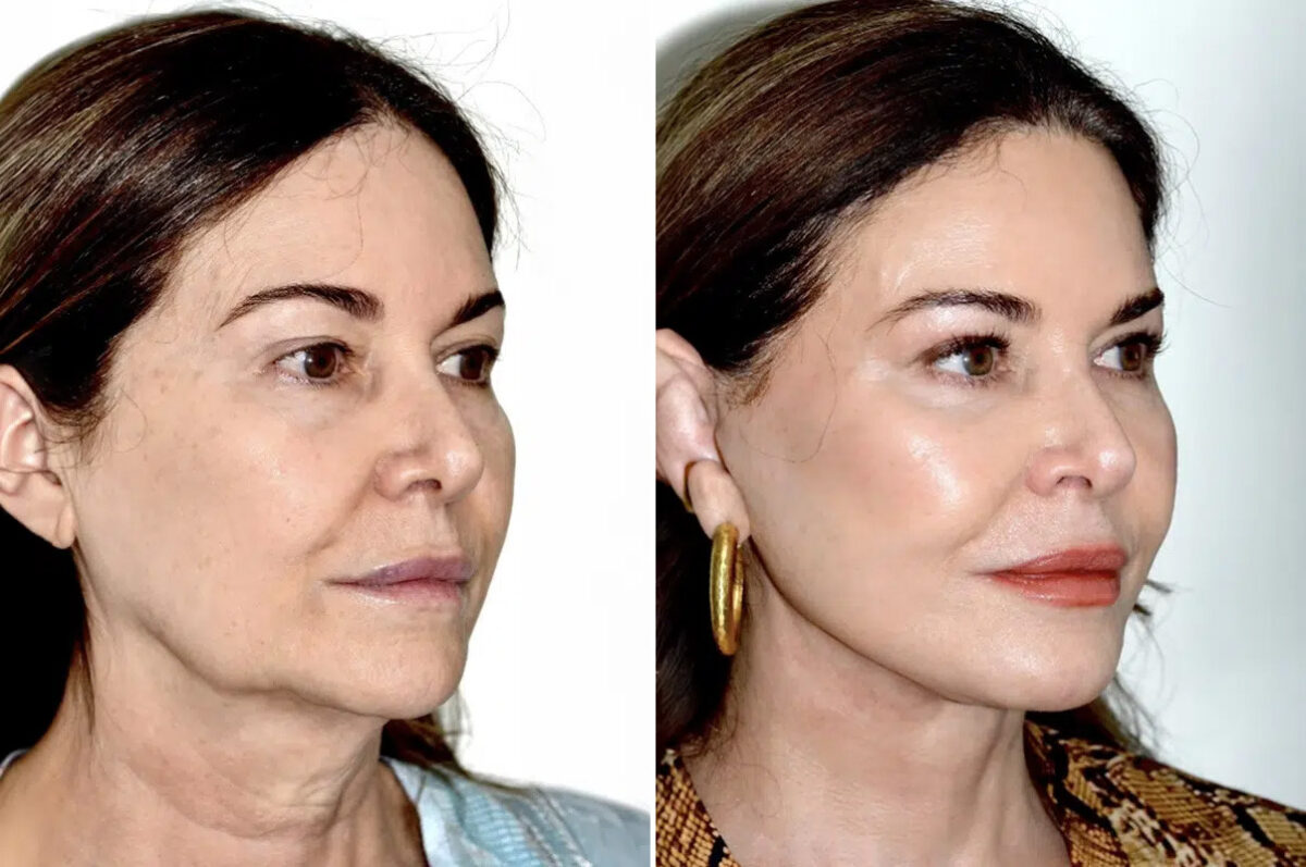 Lifting facial (facelift) fFotos de Antes y Después en Miami, FL, Paciente 17869