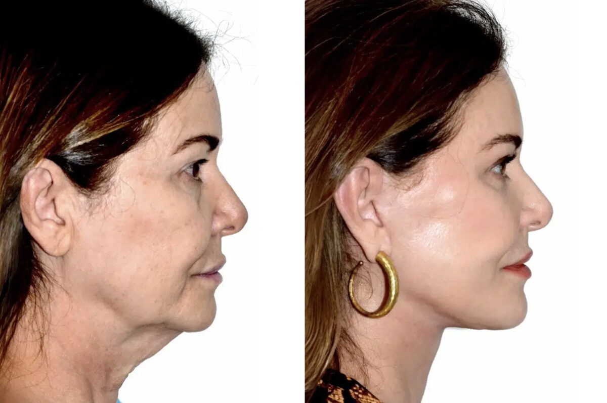 Lifting facial (facelift) fFotos de Antes y Después en Miami, FL, Paciente 17869